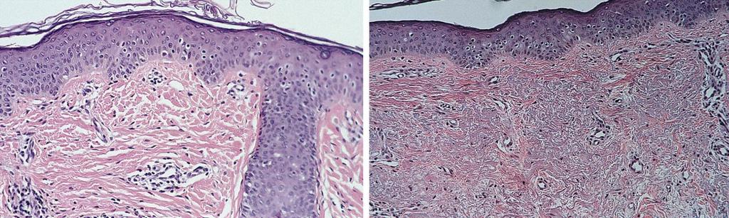 Figure 7. Photomicrographs of a biopsy specimen 6 months after resurfacing showing fibroplasia. Left, Erbium:YAG laser treated side (fluence 7.6 J/cm 2 ; 8 passes).
