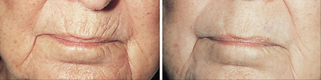 Figure 9. Wrinkle improvement. Left, Subject before resurfacing. Right, Subject 6 months after resurfacing. Subject's right side was treated with the carbon dioxide laser (fluence, 6.