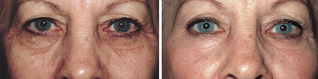The blinded panel gave an improvement score of 4 (excellent) to both sides. Figure 10. Wrinkle improvement. Left, Subject before resurfacing. Right, Subject 6 months after resurfacing.