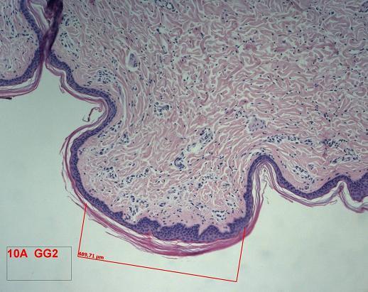2 days after irradiation: A very superficial inflammatory reaction is visible in the epidermis with hyalinization of the collagen fibers ( edema ) and a mild inflammatory infiltration in the