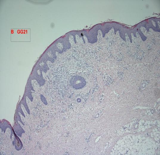 The inflammatory reaction in the papillary dermis is still mild.