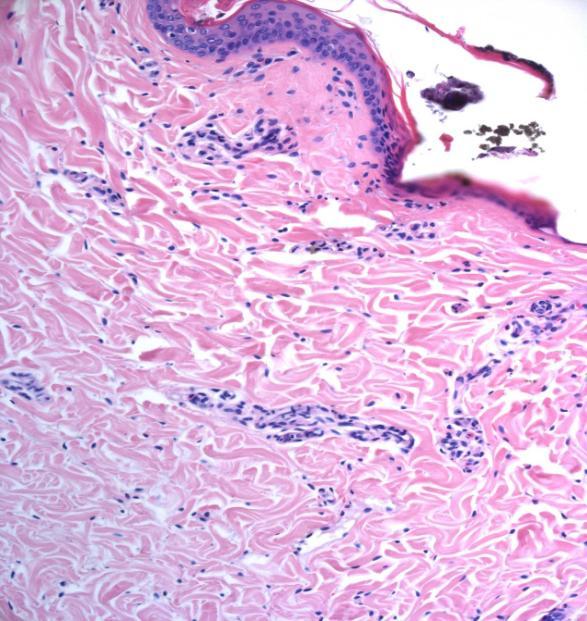 80 J/cm 2 The skin treated at 80 J/cm 2 showed total epidermis removal with evident residual thermal damage in the superficial dermis comprising a layer of frank collagen coagulation in the