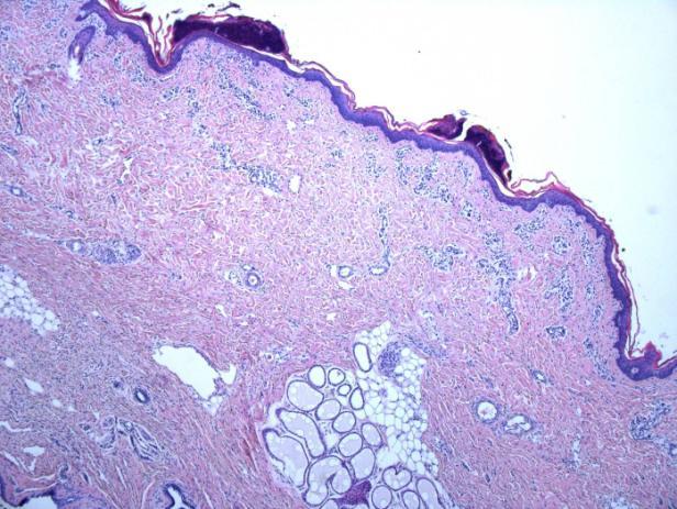 The mild to moderate inflammatory infiltrate was present in the upper papillary dermis, with a slightly higher density compared to the 40 J/cm 2 specimens (see table 4).