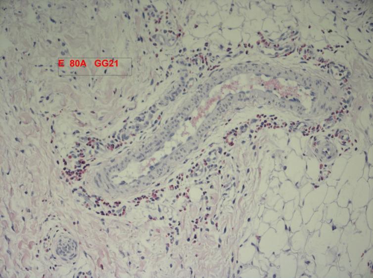 inflammatory process infiltration and evident vasculitis. Collagen remodeling is beginning in tall dermal layers. The depth of the reaction is around 1500-2000 microns.