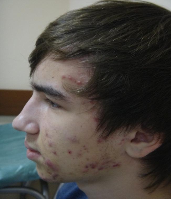 Clinical case study Patient S. 16 years. The patient visited the LLC "Professor Yutskovskaya s Clinic" complaining of a rash on the face and neck.
