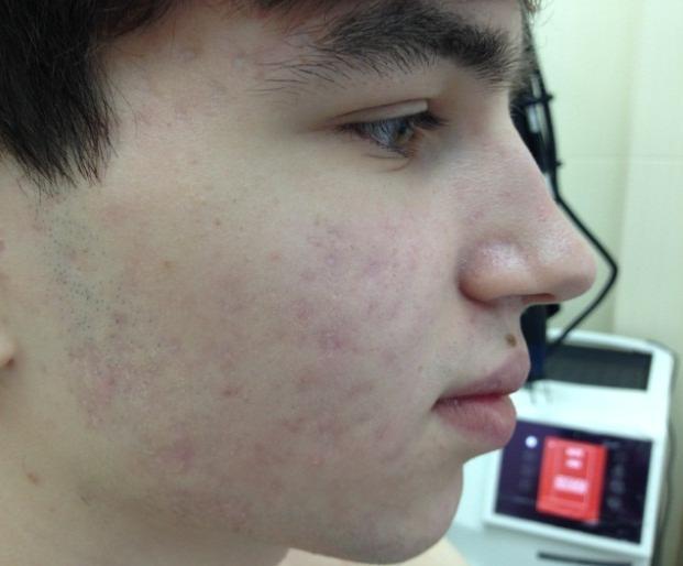 J/cm3. Fig 3. The disease pattern after the 1st phase of post-acne treatment.