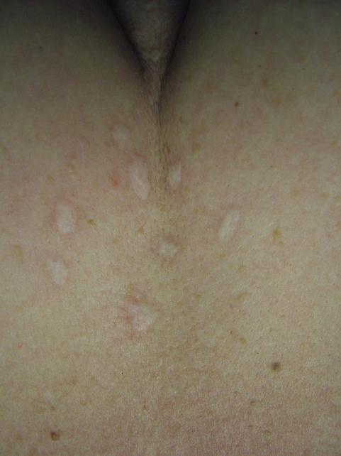 Scarring possible if deeper than epidermis or superficial dermis.