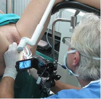 Fotona Laser SUI Therapy Minimally invasive treatment method Courtesy of Dr.