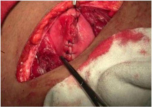 Gynecology Applications Laparotomy procedures benefits of NdYAG laser: Clean dissection of muscle tissue without charring Better cauterization in