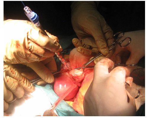 NdYAG Laparotomy procedures Example of utilization of new