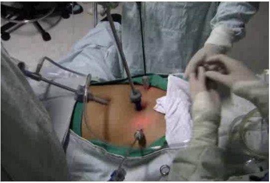 Gynecology Applications Laparoscopic procedures benefits of NdYAG laser: Can cut and coagulate while submerged under fluid Minimizes post-op adhesions