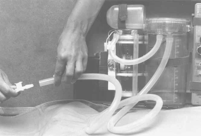 How to suction 1. Wash your hands well. 2. Open the catheter package and connect the catheter to the suction machine tubing. Turn on the suction machine. 3.