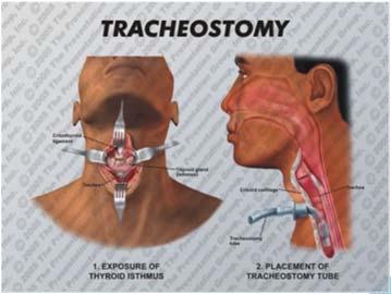Procedure has been performed for thousands of years First described in 1909 open surgical tracheostomy Percutaneous dilatational tracheostomy first performed in 1985 The most common reason patients