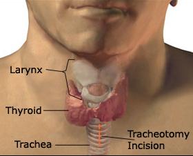 Polling Question 3 Tracheotomy Procedure A tracheotomy is only done in the operating room. A. True B.