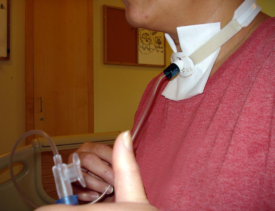 How to suction your trach 1. Rinse the suction catheter before use by suctioning normal saline from the small cup. 2. Put the suction catheter about 10-12 cm (3-4 inches) into your trach.