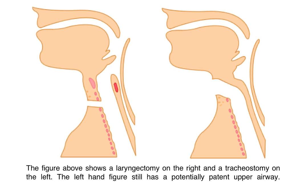 What type of tracheostomy does my