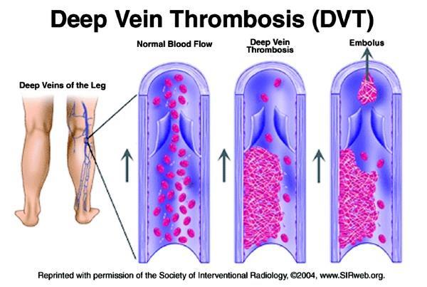 info@sentinelsystem.org 20 Gardasil & venous thromboembolism: Motivation Signal from VAERS, although 90% of the 31 had a known VTE risk factor (Slade et al.