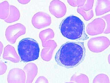 Introduction Figure 16. Typical morphology of CLL cells in peripheral blood.