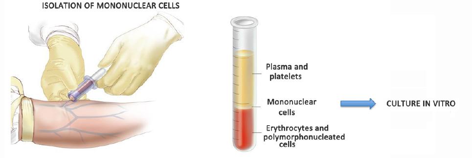 Materials and methods leukocytes contain B cells, T cells and monocytes in various proportions according to the patient and the stage of the disease.