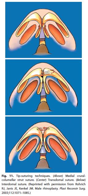 A Practical Approach to Rhinoplasty Plast Reconst Surg CME. 2016; 137(4). REFERENCES 1. Codner et al. Blepharoplasty and Brow Lift Plastic & Reconstructive Surgery.