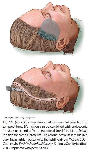 Figure 1. Incision placement for temporal brow lift From Codner et al.