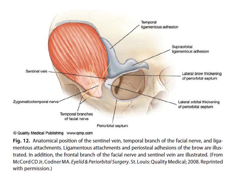 Anatomical position of the sentinel vein, temporal branch of facial nerve and