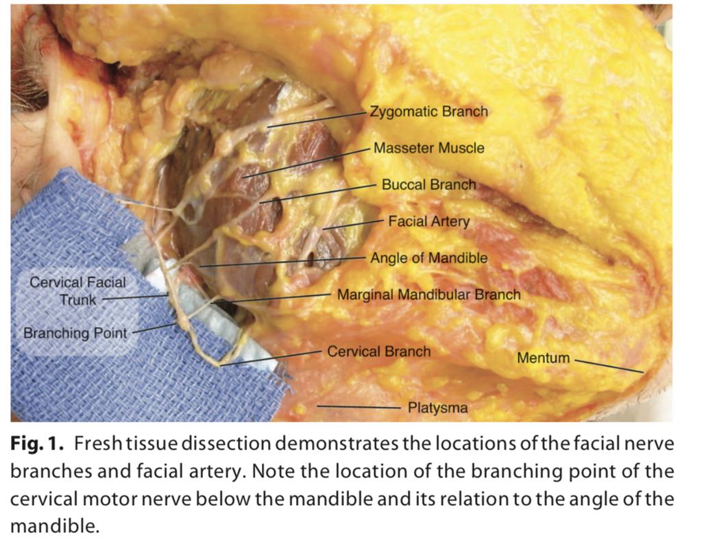 4. Marginal Mandibular 5. Cervical B. Facial Retaining Ligaments Figure 4. Fresh tissue dissection demonstrates the location of the facial nerve branches and facial artery.