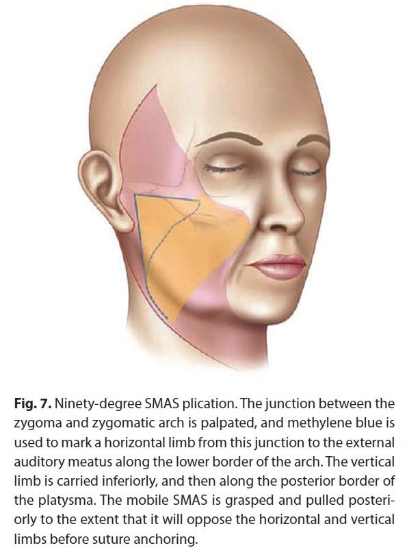 1. The facial skin is undermined and a separate flap of SMAS is elevated and sutured superior-laterally to reposition the SMAS. E.