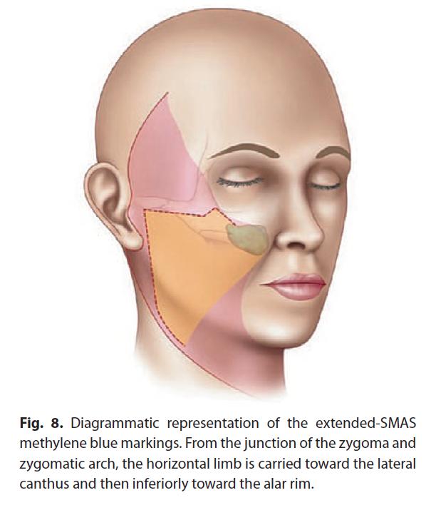 A limited amount of facial skin undermining is performed and then the SMAS and skin are left adherent to each other as a composite flap while a
