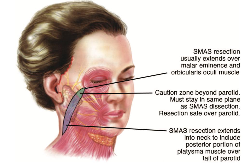 Figure 6. Design of SMAS/platysma resection. The level of resection is superficial to the parotid masseteric fascia that overlies the facial nerve branches. From Baker D. Modified lateral SMASectomy.