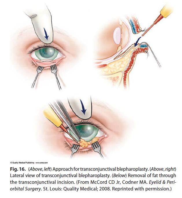 Figure 7. (Left) Approach for transconjunctival blepharoplasty; (Right) Lateral view of transconjunctival blepharoplasty; (Below) Removal of fat from the transconjunctival incision. From Codner et al.