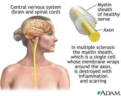 What happens if the myelin sheath is damaged?