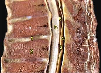 In this midsagittal picture #3 is the dura mater, #5 is the spinal cord, # 4 is the epidural space, and #6 is