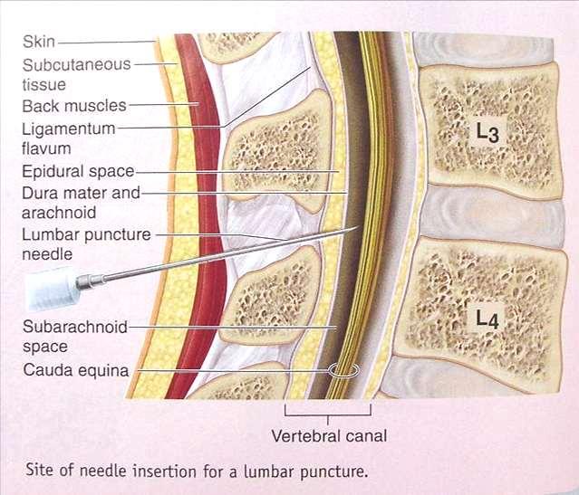 The tip of the needle is inserted into the subarachnoid space