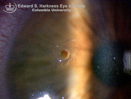 Corneal Foreign Bodies Remove the FB under the best magnification Evert the eyelid to rule out