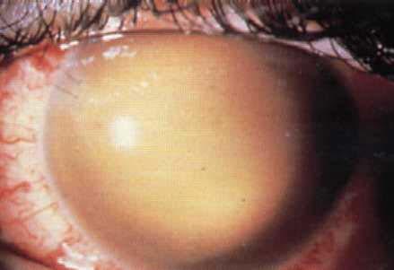 in 30% Uncontrolled glaucoma or blood