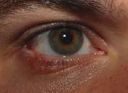 eyelid margin