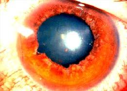cataract 