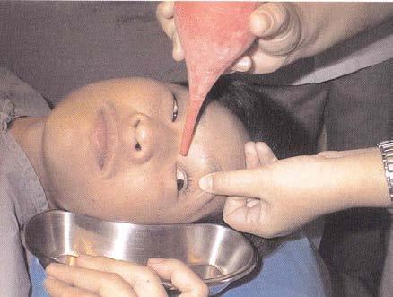 Chemical Ocular Injury : Management Immediate copious irrigation with a minimum of 1-2 L of saline or until ph