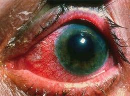 A 55-year-old woman with a red eye, blurred vision with halos, nausea, and vomiting VA - HM Conjunctival