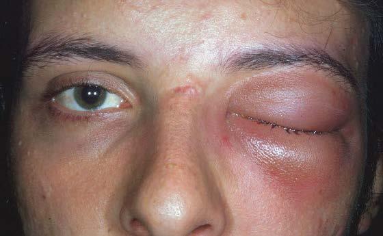 A 40-year-old man with left eyelid