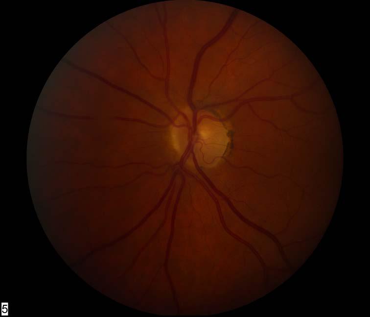 A 73-year-old woman with acute visual loss of right eye, headache, anorexia and weight loss VA 10/200,