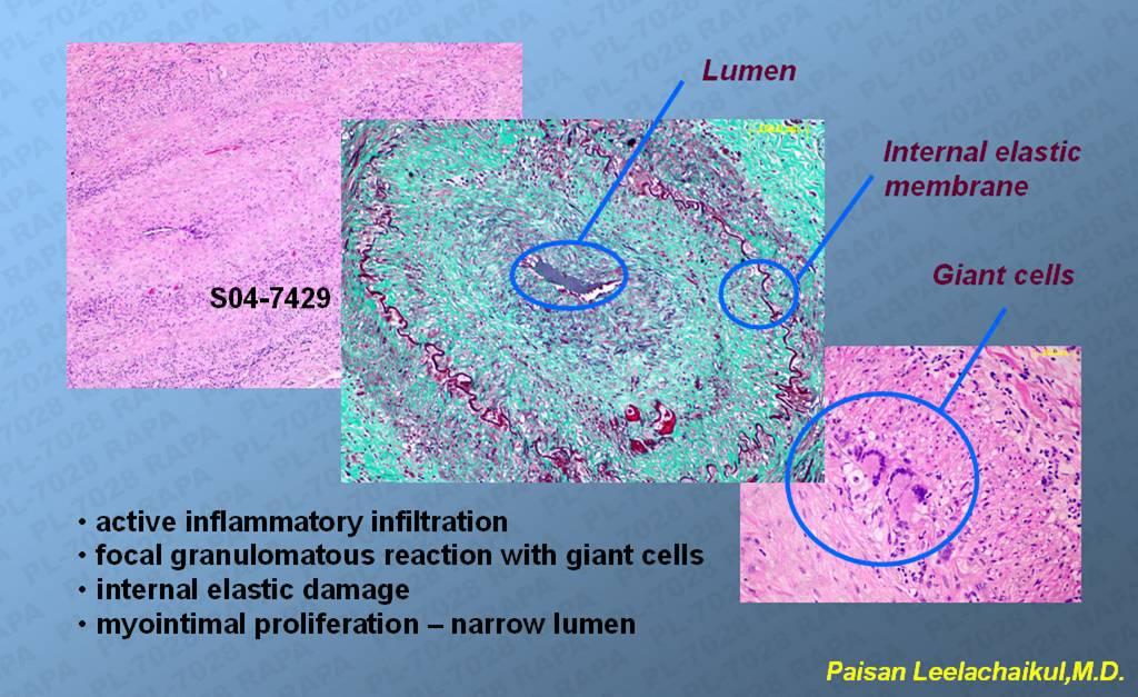 Pathology : Giant Cell