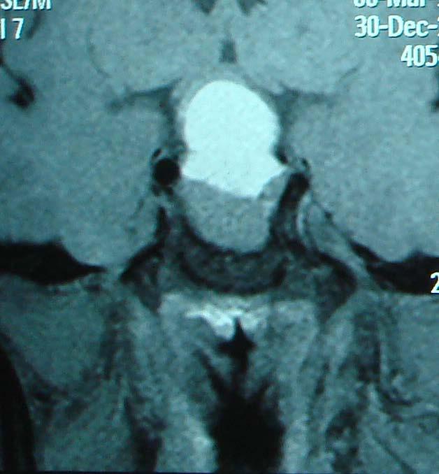 A 40-year-old woman with sudden