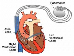 Adds a left ventricular lead Can be a pacemaker or