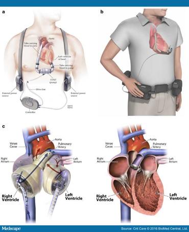 Mechanical artificial heart implanted in the chest and connected to an electrical source.