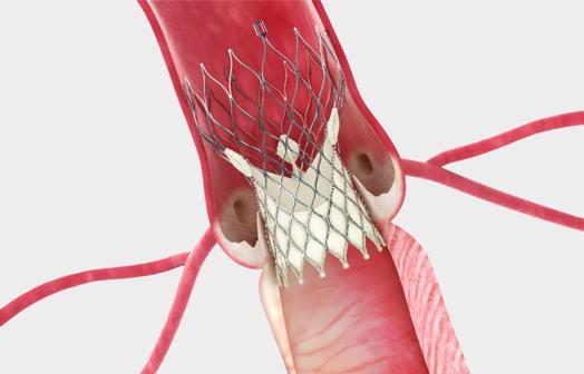 Minimally invasive procedure (aortic valve stenosis).