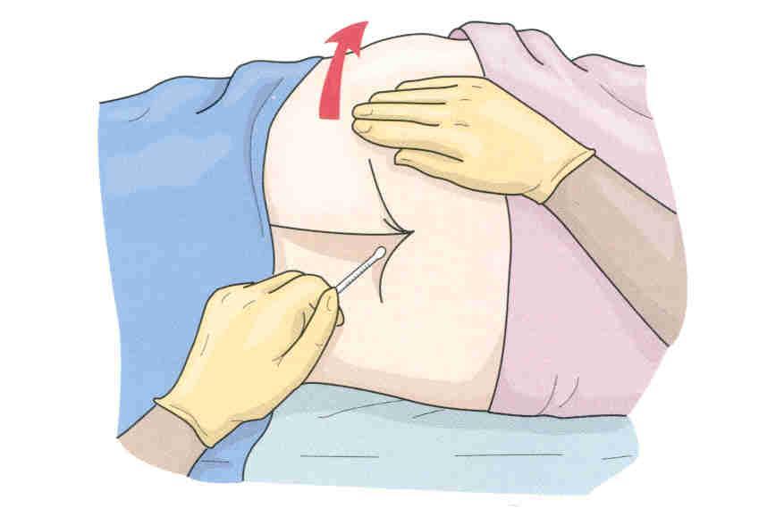Taking a Rectal Temperature Lubricate the thermometer before inserting into the rectum Place patient