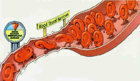 Hypertension High blood