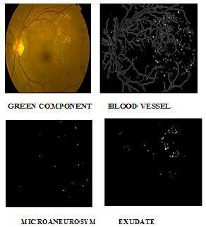 Blood Vessels Normal Class Fundus Image Green & Grayscale Component Excudates Detection Artificial Neural Network Mild Class Fig 4: Overall Block Diagram for Detection of DR The last step in the